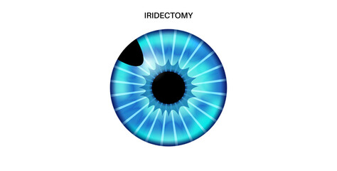 Iris melanoma anatomy