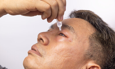 Senior man use antibiotic eye drops to treat swollen eye from insect bite.