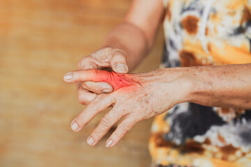 Close up of old woman hands with Arthritis. Concept of injury, arthritis, or carpal tunnel syndrome.
