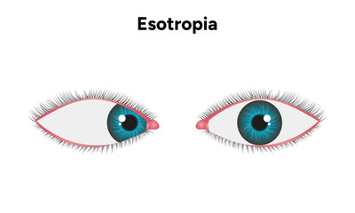 Eye problem disease strabismus Esotropia 