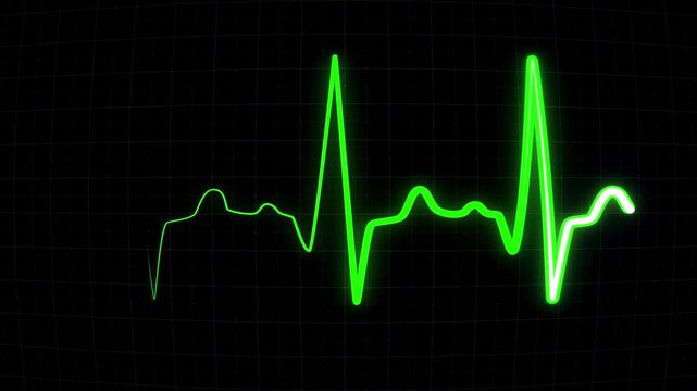 Heart beat frequency on the screen of electrocardiogram machine in close-up. EKG or ECG heart rate flatline