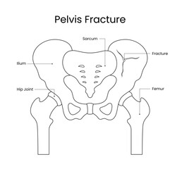 Diagram of Pelvis Fracture Sketch