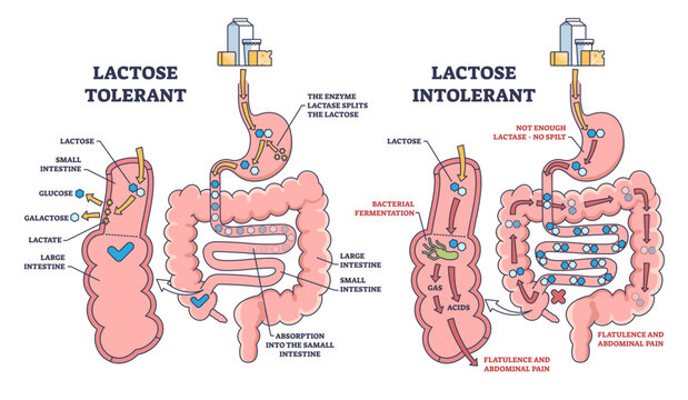 Lactose intolerance and tolerance medical process differences outline diagram, transparent background. Labeled educational anatomical digestive tract splitting explanation.