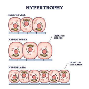 Hypertrophy, hyperplasia or healthy muscular cells comparison outline diagram, transparent background. Labeled educational scheme with increased cellular fluid after weight lifting.