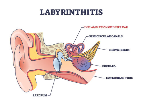 Labyrinthitis as inner ear infection and medical inflammation outline diagram, transparent background. Labeled educational scheme with painful condition and medical cause.