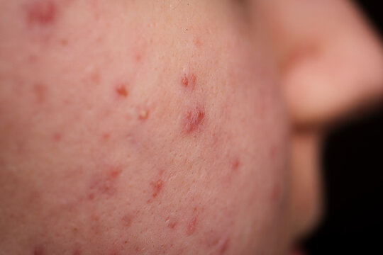 Skin acne background. Closeup acne pimple. Treatment for acne skin. Problem skincare. Pimples, acne, pores, scars. Natural skin. Skin care treatment. Pimples on face.