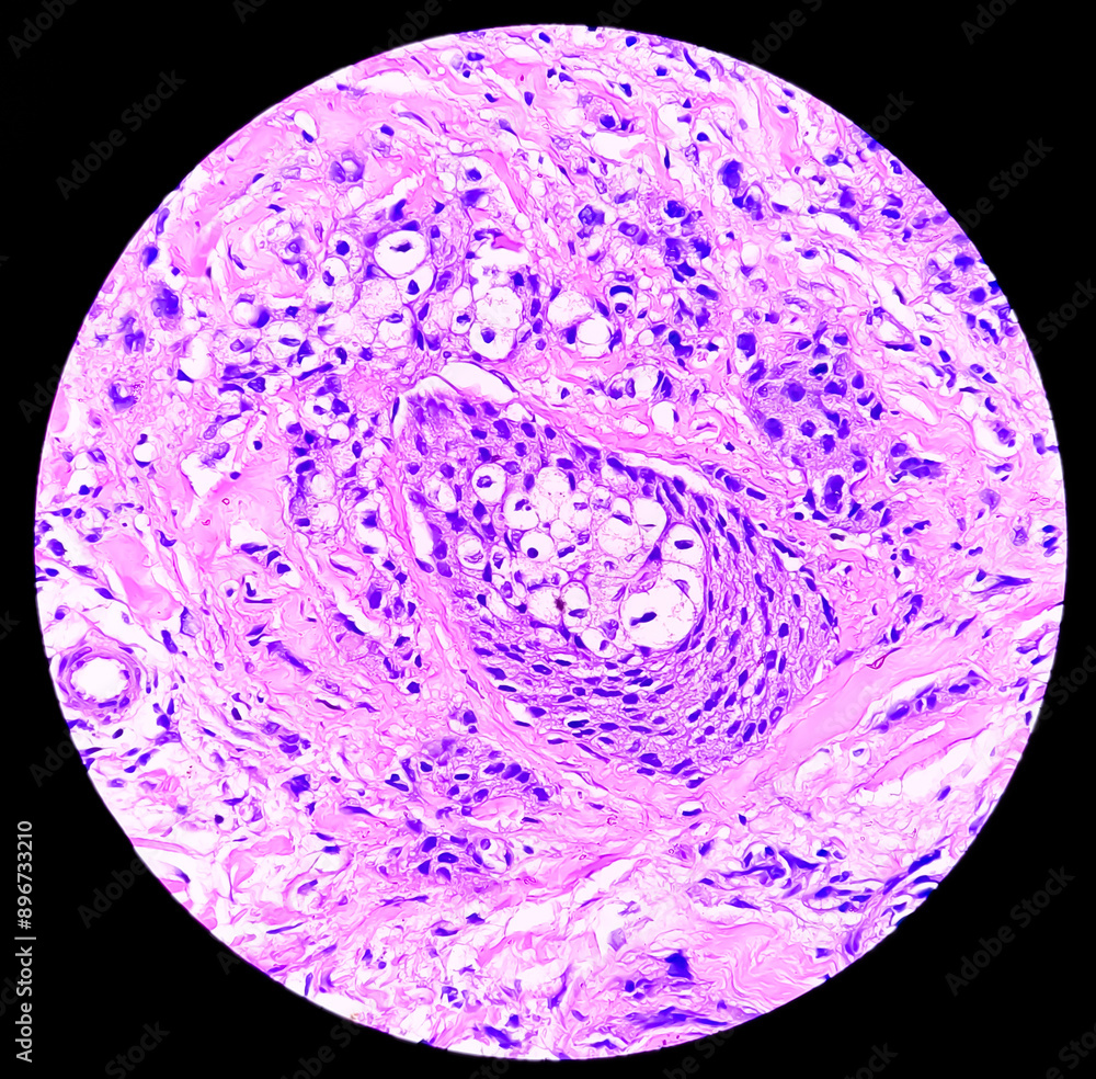 Sticker Breast biopsy photomicrograph of infiltrating duct cell carcinoma (NOS), grade-1