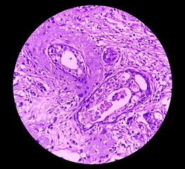 Breast biopsy photomicrograph of infiltrating duct cell carcinoma (NOS), grade-1