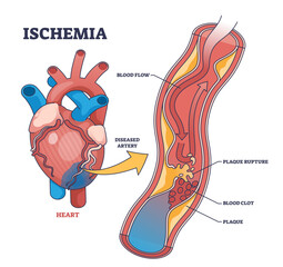 Ischemia as medical condition with blood flow blockage outline diagram, transparent background. Labeled educational anatomy scheme with plaque rupture, blood clot and restricted.