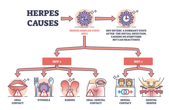 Herpes causes and medical skin HSV virus transmission outline diagram, transparent background. Labeled educational list with dermatological problem activation causes illustration.