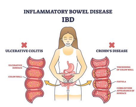 Inflammatory bowel disease or IBD with Crohns condition and ulcerative colitis outline diagram, transparent background. Labeled educational scheme.