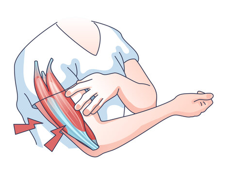 Muscle weakness with weak and fatigue muscular system outline concept, transparent background. Medical issue with physical disorder and arm cramps, exhaustion, pain or dystrophy illustration.
