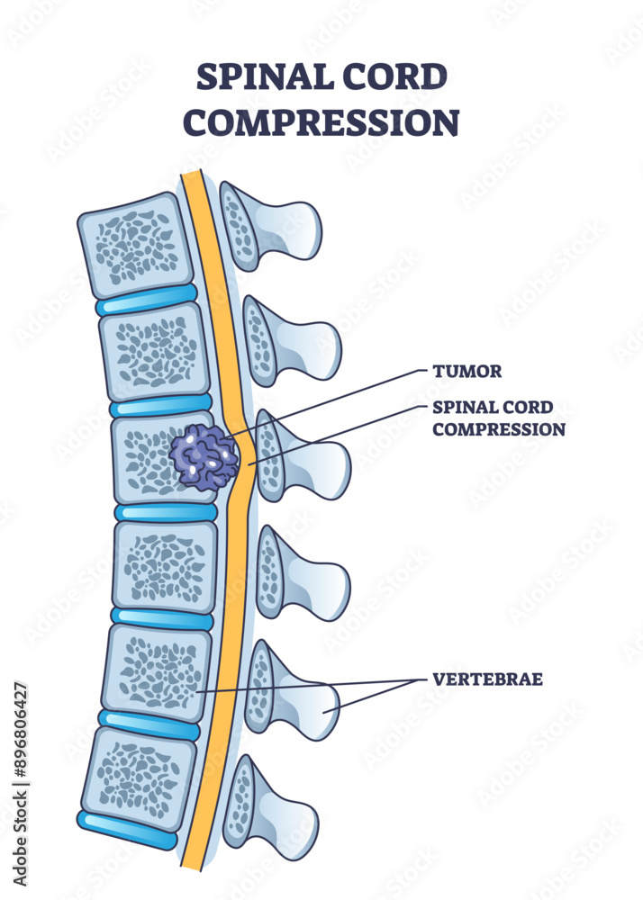 Poster spinal cord compression with tumor and vertebrae condition outline diagram, transparent background. 