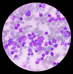 Bone marrow study smear picture of Acute Myeloid Leukemia, Blast cell, Granulopoiesis. Hematology. Blood cancer.