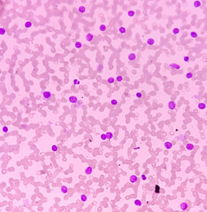 Bone marrow study smear picture of Acute Myeloid Leukemia, Blast cell, Granulopoiesis. Hematology. Blood cancer.