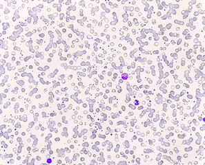 Anisocytosis anisochromia with both microcytic hypochromic and macrocytic hypochromic RBC with rouleaux formation, Dimorphic anemia. 