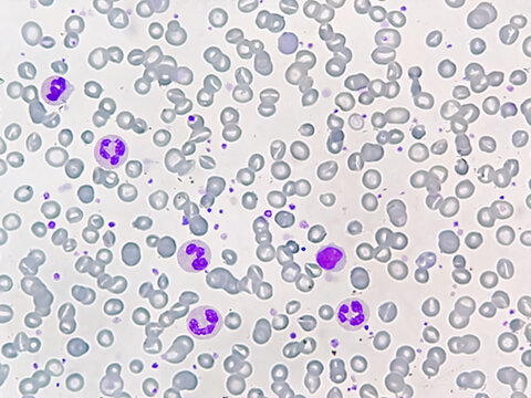 Anisocytosis anisochromia with both microcytic hypochromic and macrocytic hypochromic RBC with rouleaux formation, Dimorphic anemia. 