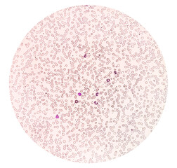 Anisocytosis anisochromia with both microcytic hypochromic and macrocytic hypochromic RBC with rouleaux formation, Dimorphic anemia. 