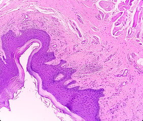 Microscopic examination showing Leukoplakia, buccal mucosa leukoplakia