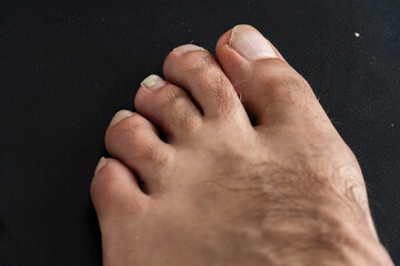 Fototapeta premium Toenail infected with a fungus isolated on black background.