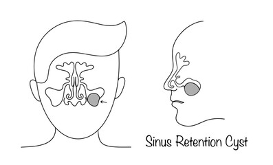 Sinus Retention Cyst