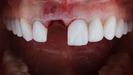 Obraz premium absence of a central tooth before prosthetics