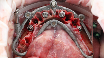 surgical dental template and installed implants on the lower jaw