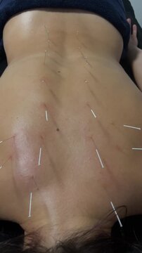 Acupuncture for woman back to relieve pain. Alternative medicine concept.