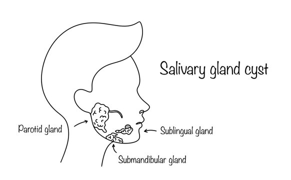 Salivary gland cyst