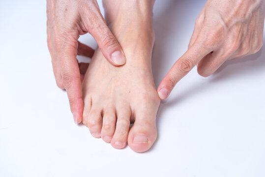 person showing bunion on his foot, close up