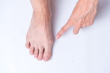 bunion on foot, arthritis, health, body medicine