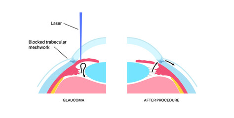 Iridectomy medical poster