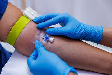 A patient with serum administered in the hospital. Serum is given to the patient. The serum that the nurse makes to her patient. While the doctor opens a vascular access to the patient.