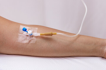 Arm of The patient while receiving an intravenous saline drip to recover from suffering from the...