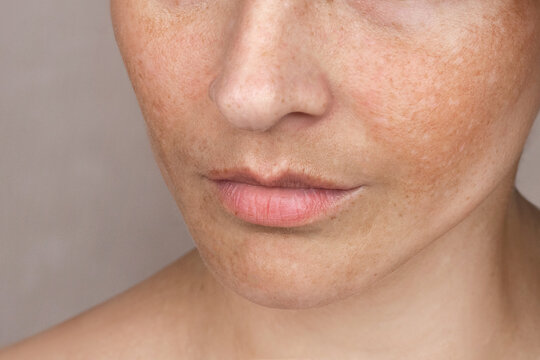 Close up caucasian woman's face with freckles or age spots. Age spots on the face melasma