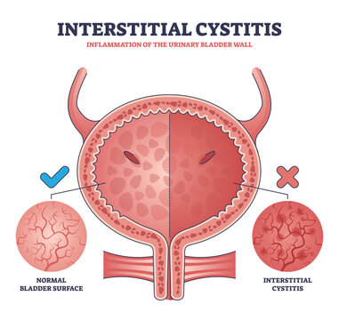 Interstitial cystitis as urinary bladder wall inflammation outline diagram, transparent background. Labeled educational urology problem and compared healthy bladder surface.