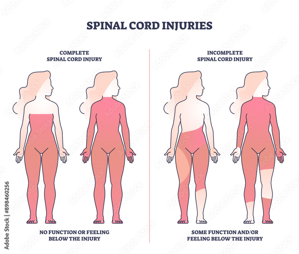 Poster spinal cord injuries with complete or incomplete trauma outline diagram, transparent background. lab