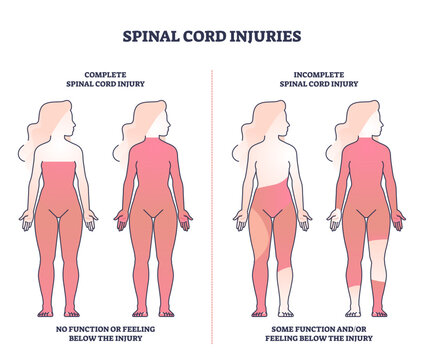 Spinal cord injuries with complete or incomplete trauma outline diagram, transparent background. Labeled educational scheme with function or feeling zones in state of paralysis illustration.