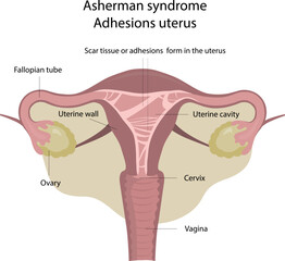 Asherman syndrome . Adhesions uterus.