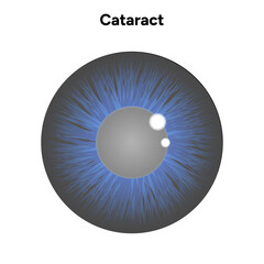 Cataract eye disease problem and blue eye