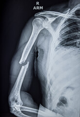 X ray of upper arm showing fracture in the shaft of humerus bone 