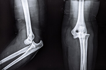 X ray film of posterior dislocation of elbow joint