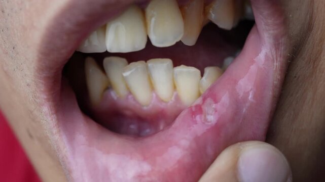 Close-up video footage of the inner lip of a man suffering from a canker sore and teeth with a lot of yellow tartar. Concept for mouth and dental healthcare.