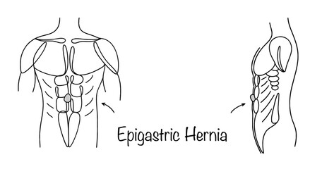 Epigastric Hernia
