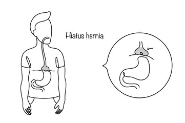 Hiatus hernia
