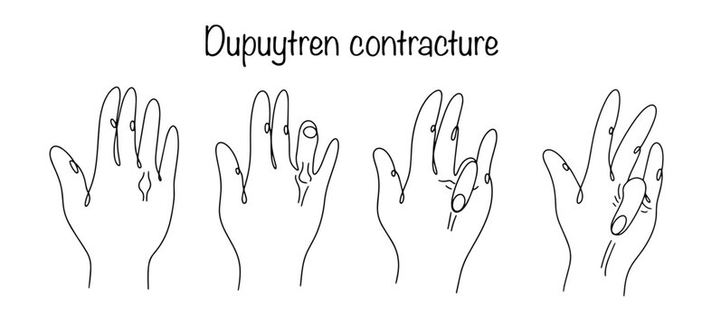 Dupuytren contracture