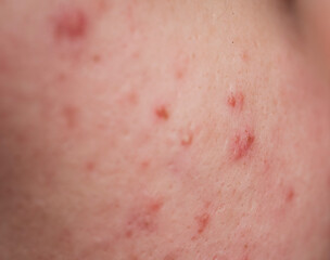 Skin texture background. Closeup acne pimple. Treatment for skin. Problem skincare. Pimples, acne,...