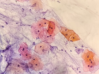 Paps smear: NILM with reactive cellular changes associated with inflammation.