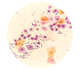 Paps smear: NILM with reactive cellular changes associated with inflammation.