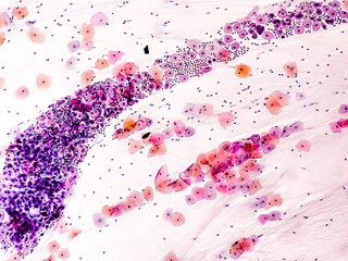 Paps smear: NILM with reactive cellular changes associated with inflammation.